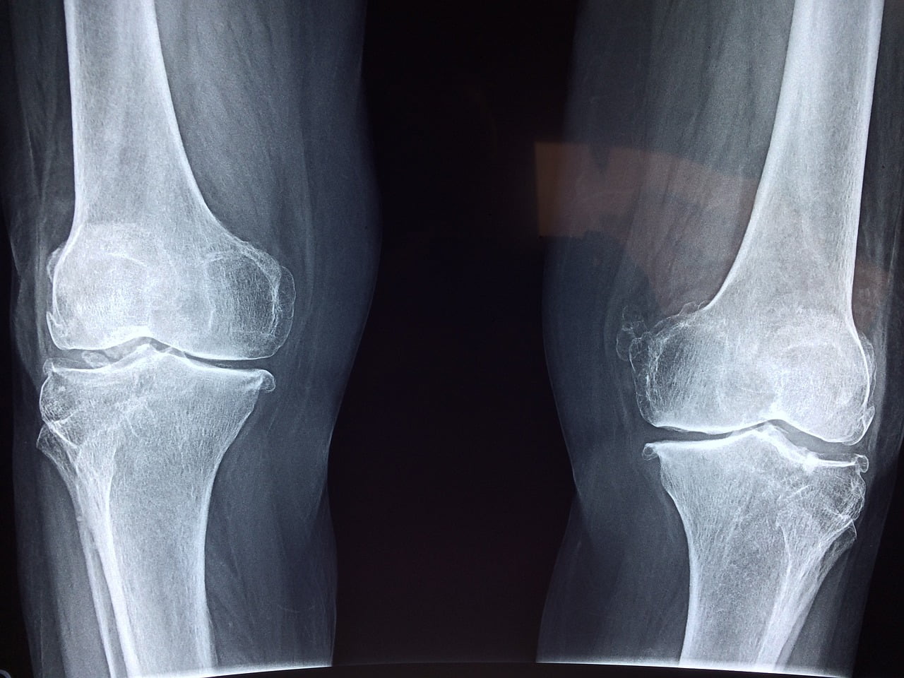 Bone spurs, x-ray of a person's knee